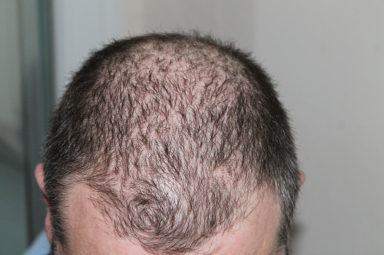 How Hair Loss Affects Men’s Mental Health How Hair Loss Affects Men’s Mental Health