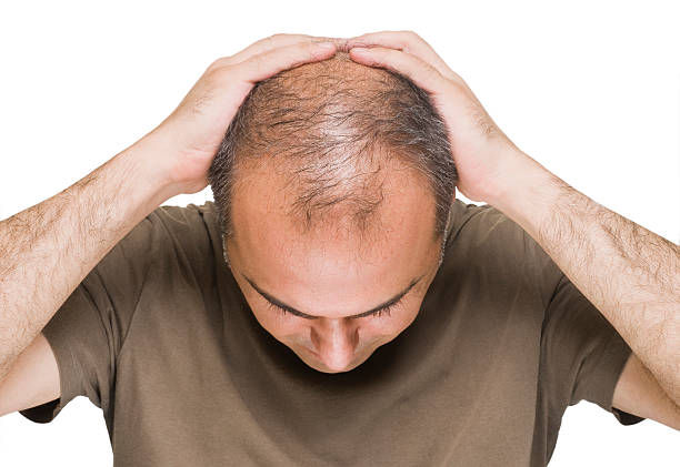 The Leading Causes Of Hair Loss Problems For Men