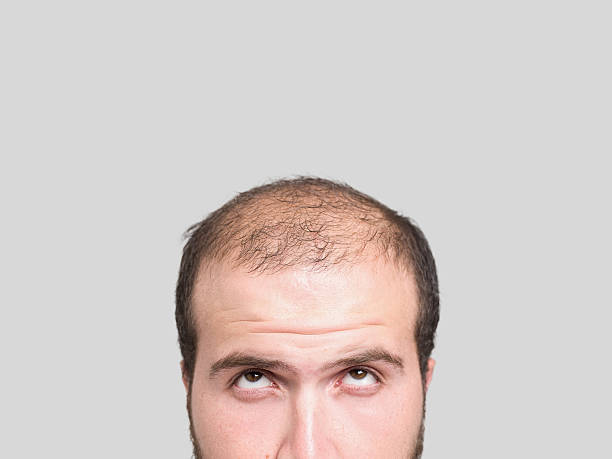 The Leading Causes Of Hair Loss Problems For Men